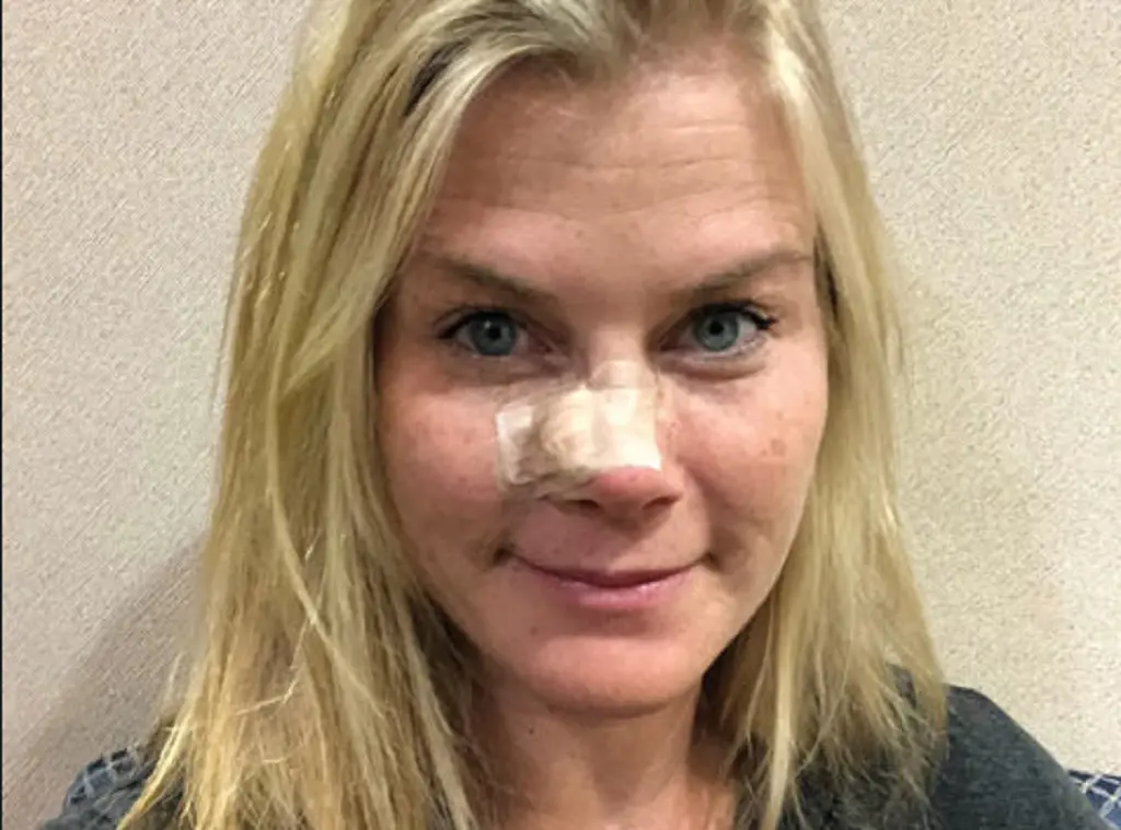Alison Sweeney post surgery of her small bump on the nose which later turned out to be a skin cancer.